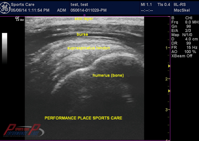 Msk Ultrasound Shoulder Orange County Huntington Beach Sports