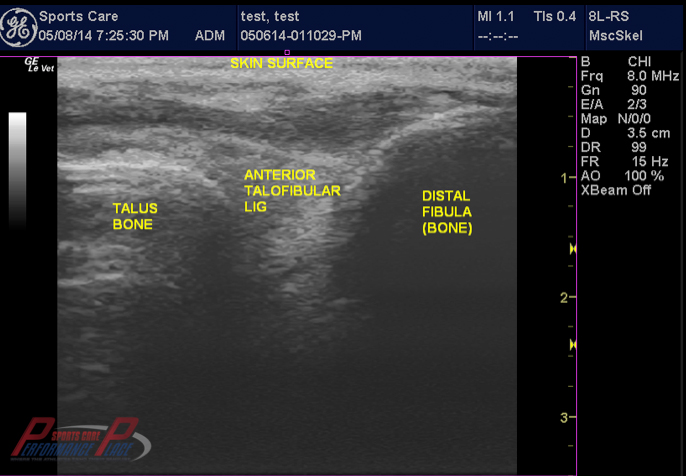 Musculoskeletal Ultarsound ATFL