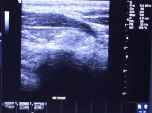 Foot Pain Musculoskeletal Ultrasound