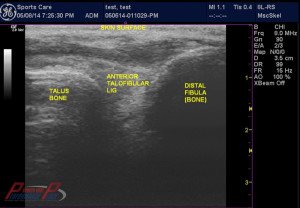 Chronic Ankle Instability MSK Ultrasound Facility