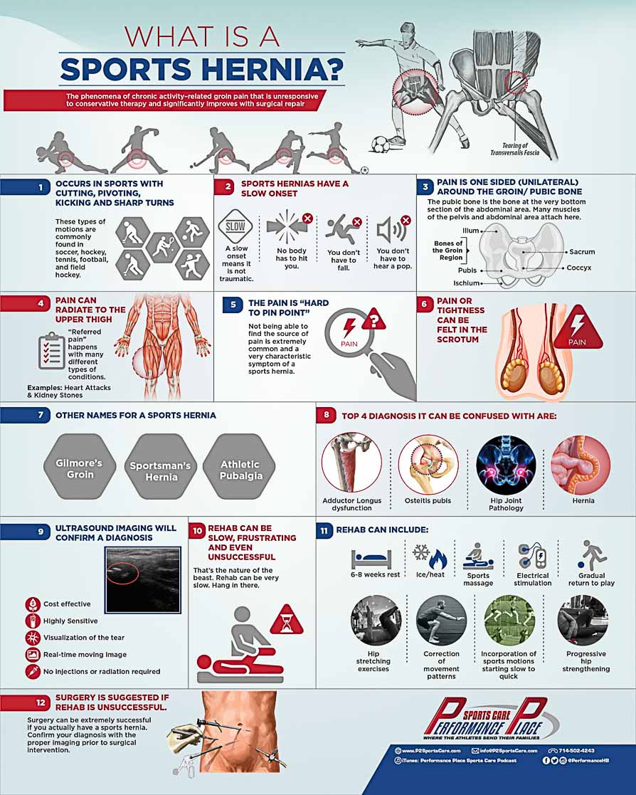 Sports Hernia Infographic