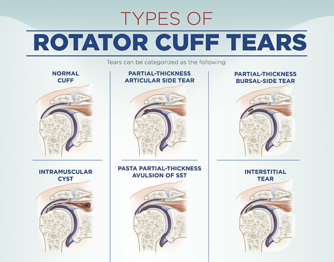 partial thickness rotator cuff tear