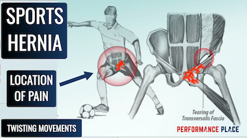 12 Truths About Sports Hernias Your Doctor Didn’t Tell You
