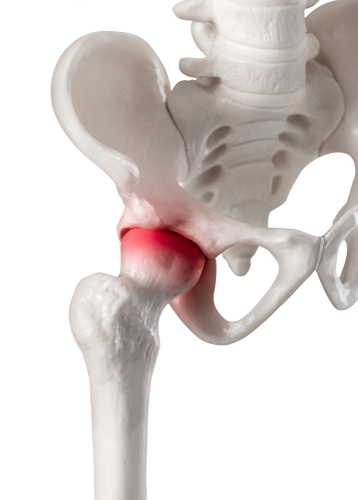 Hip Impingement Running