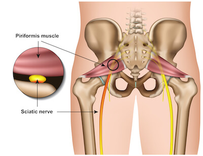 Piriformis Syndrome Running