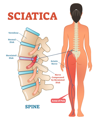 sciatica-leg-pain-location-symptoms
